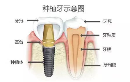 种植牙悲剧，咬黄瓜引发牙冠碎裂事件