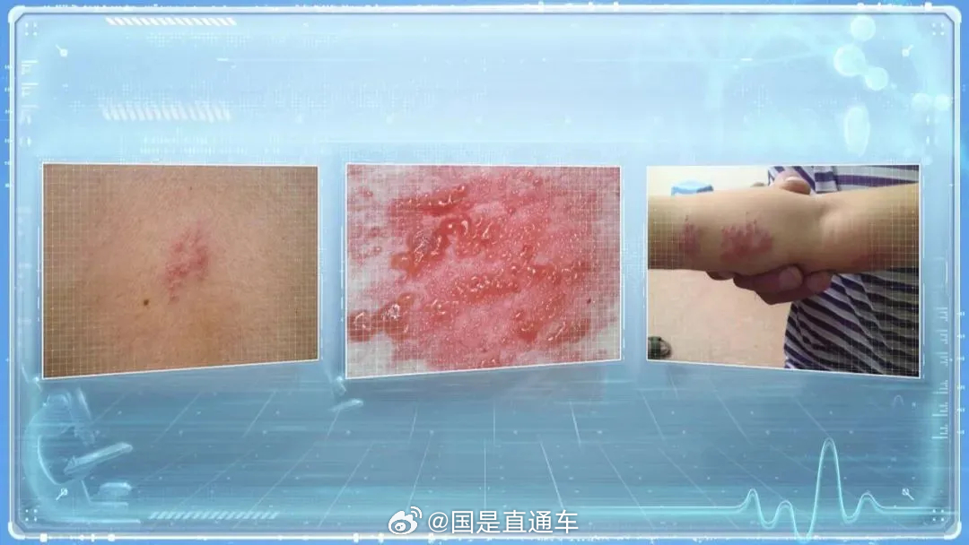 拆快递后揉眼引发眼部带状疱疹病例警示