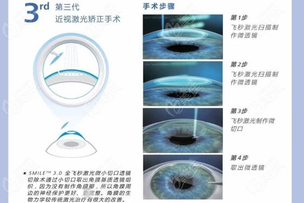 重塑视界之光，最新近视眼治疗方法揭秘