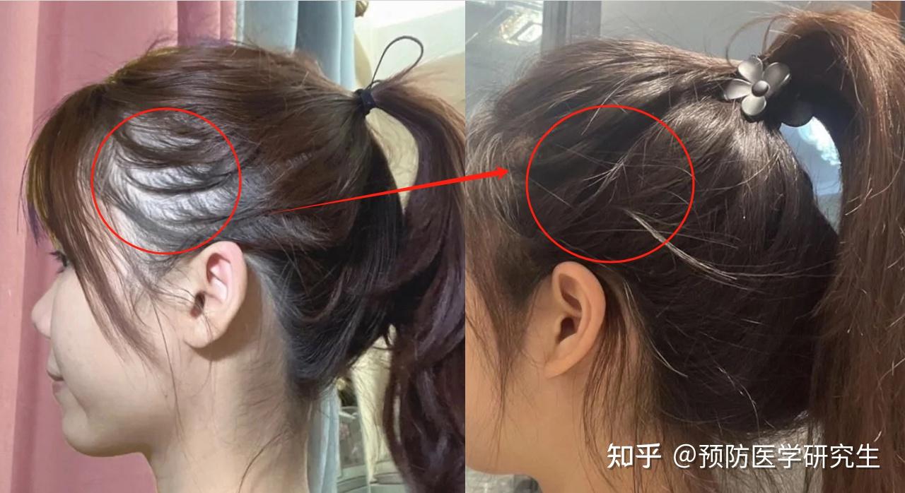 脱发最新突破，秀发之旅与心灵自然美景的探索之旅